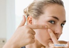 Разница между угрями и прыщами